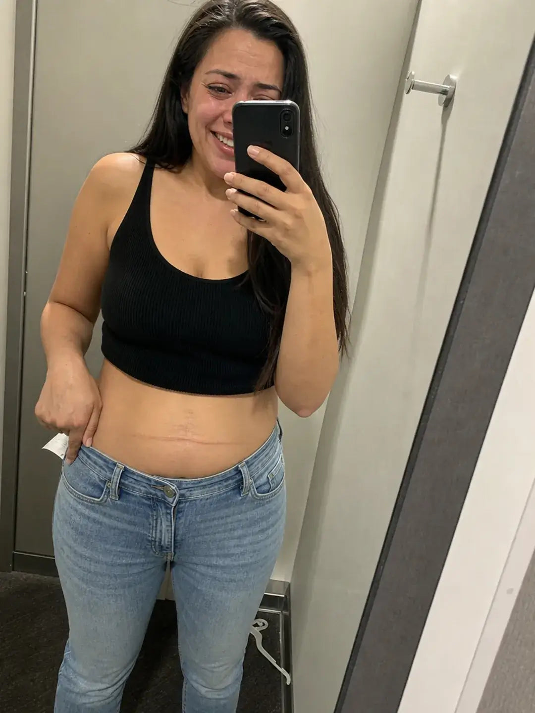 Medazy C section scar result